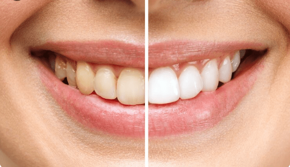 Teeth Whitening
